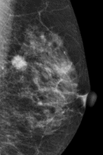 乳がんの所見の一例