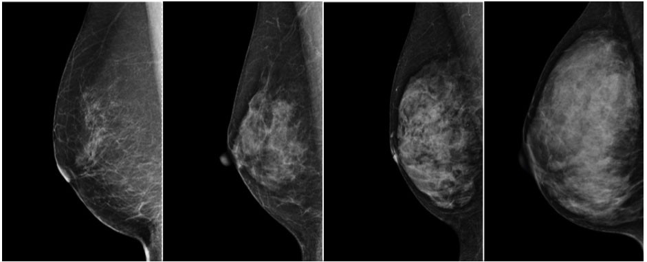 高濃度乳房（デンスブレスト）とは