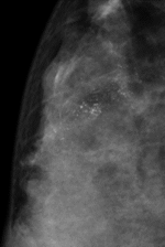 上の図は石灰化の所見を示しています