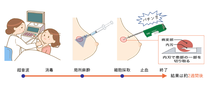 針生検の流れ