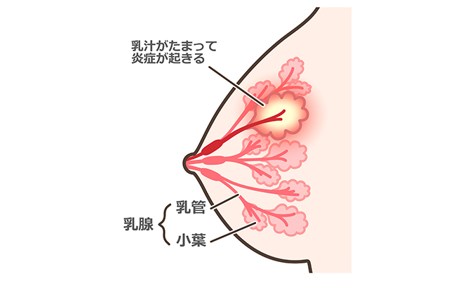 乳腺炎とは